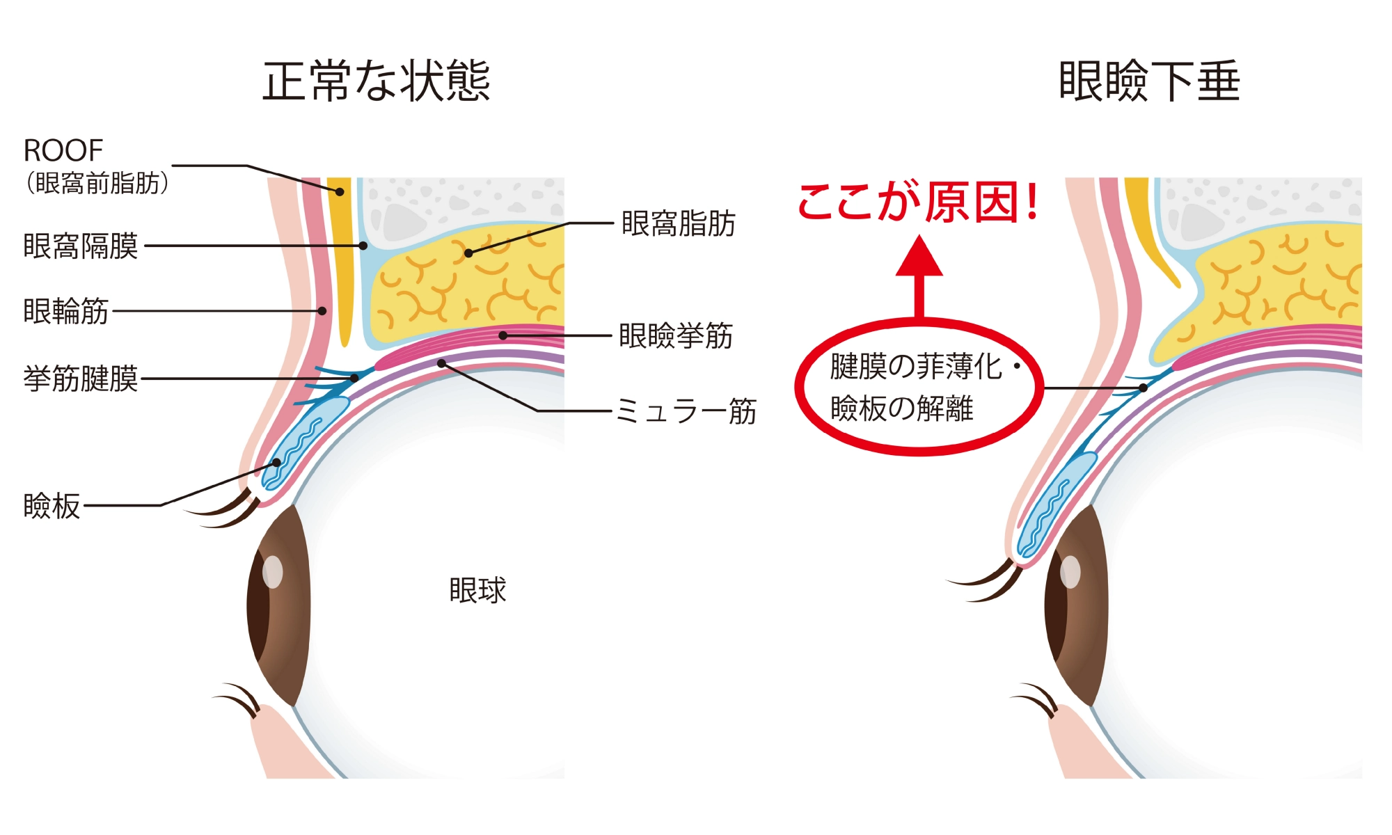 眼瞼下垂の状態