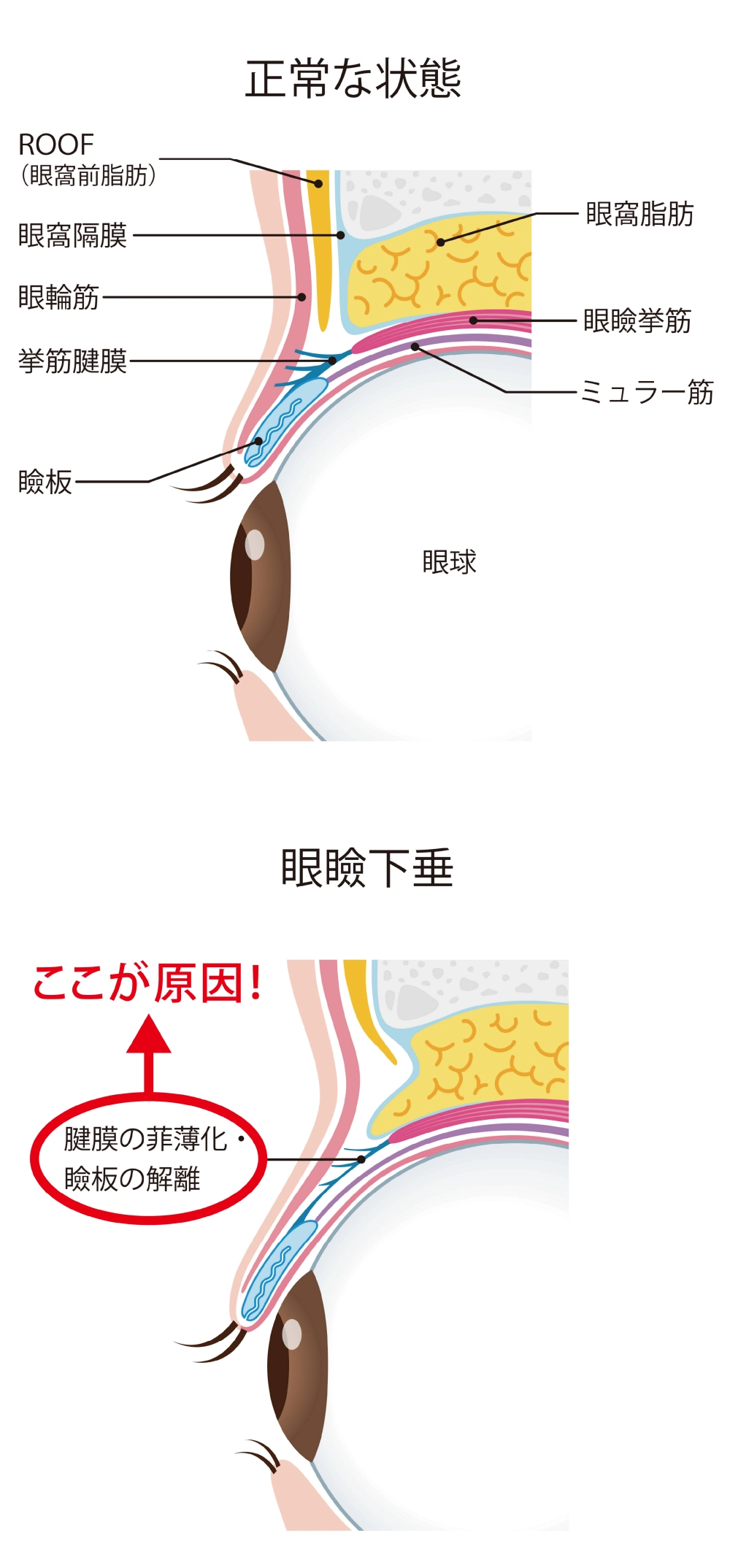 眼瞼下垂の状態