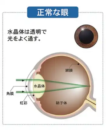 正常な目