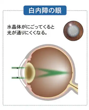 白内障の目