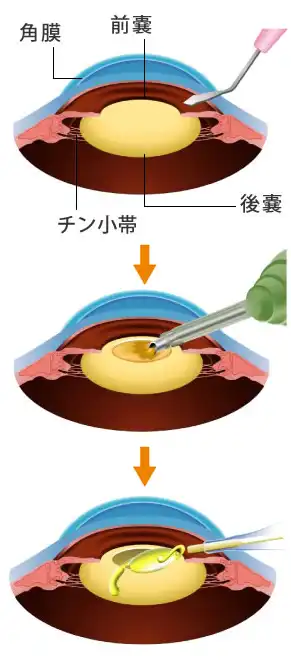 白内障手術