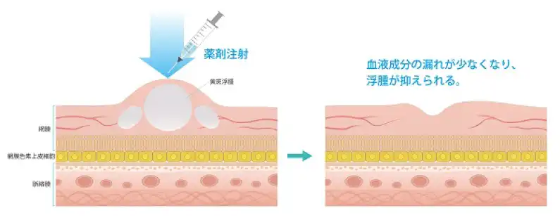 硝子体注射