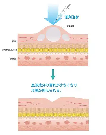 硝子体注射